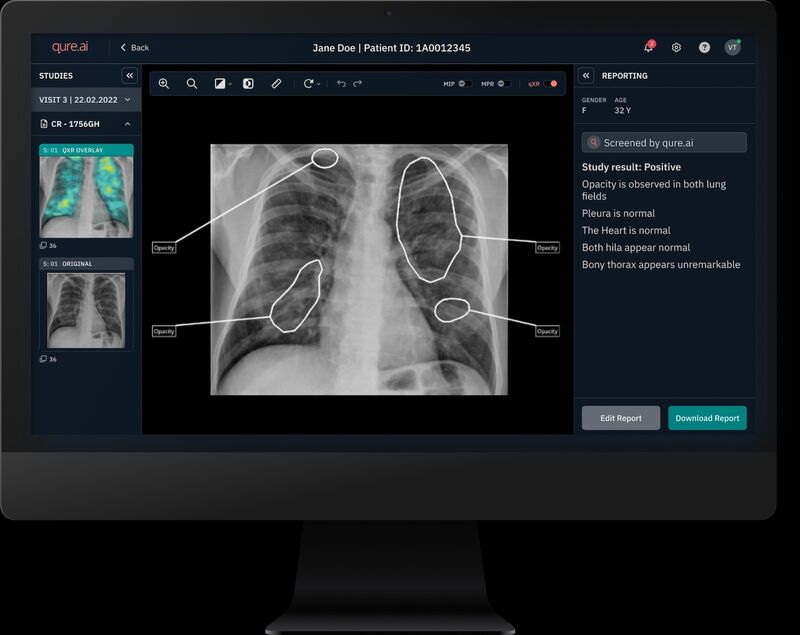 Qure.ai's chest X-ray interface.