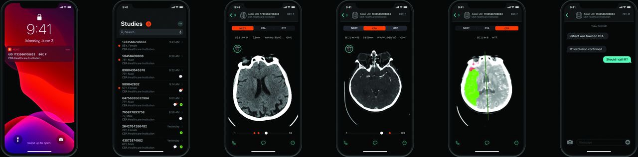 Aidoc's intracranial hemorrhage detection triages urgent cases and highlights suspected bleeds for radiologist review.